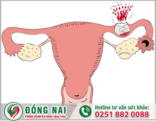 Mang thai ngoài tử cung nguy hiểm như thế nào?