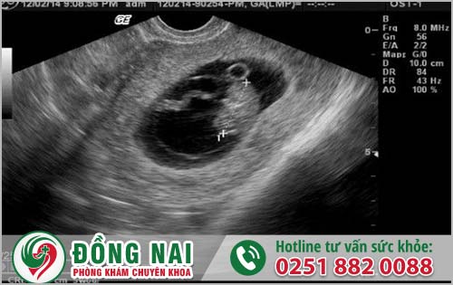 Thai 9 Tuần Tuổi Nên Phá Như Thế Nào Là An Toàn? Xử Lý Ở Đâu Uy Tín?